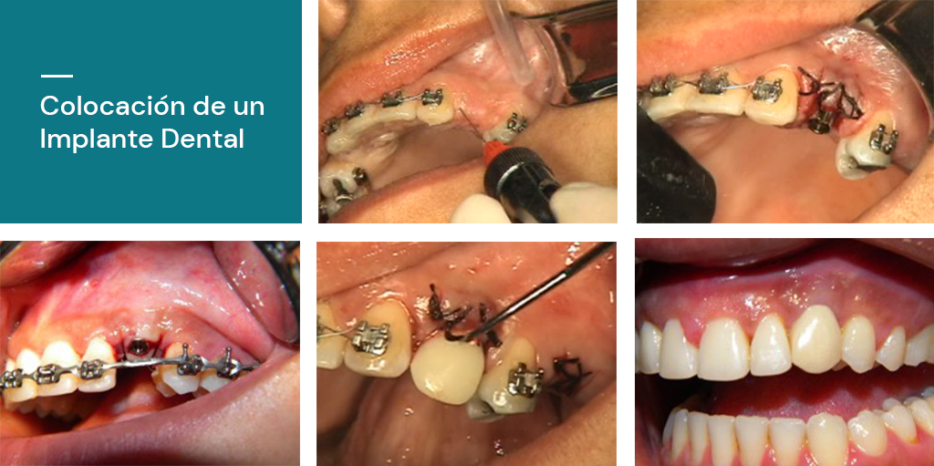 Colocacion Implantes Dentales