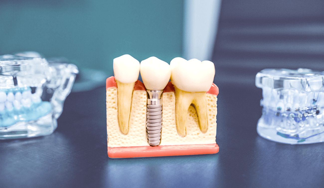 Implantes Dentales
