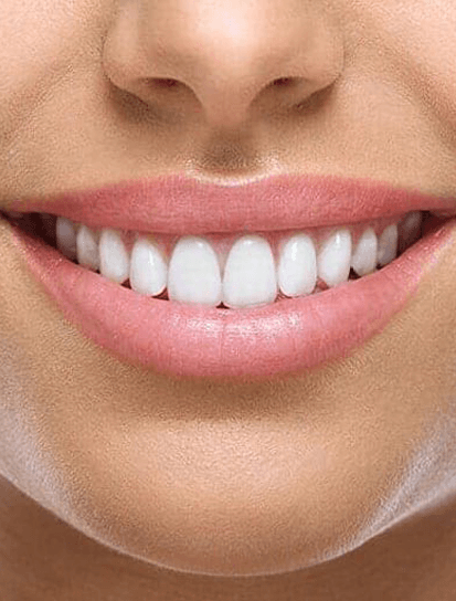 Sonrisa perfecta despues de cirugia cosmetica
